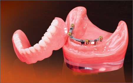 Implant Overdentures