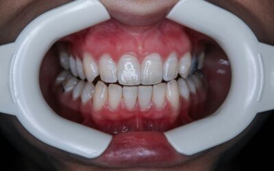 Biocompatible Materials Used in Dental Restorations